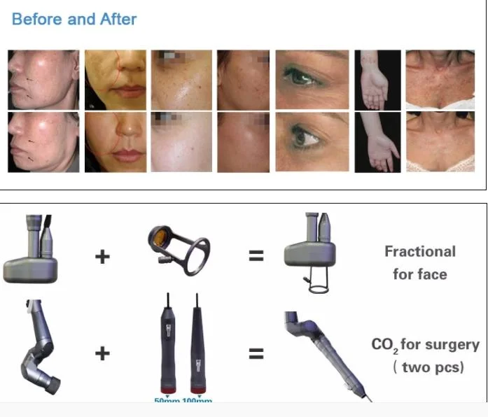 Vertical Professional Medical CE ISO Fractional CO2 Laser for Acne Scar Removal Skin Care