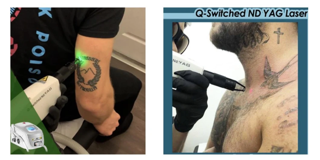 Spectra ND YAG Laser Best New Portable Q Switch ND YAG Laser Tattoo Removal Machine