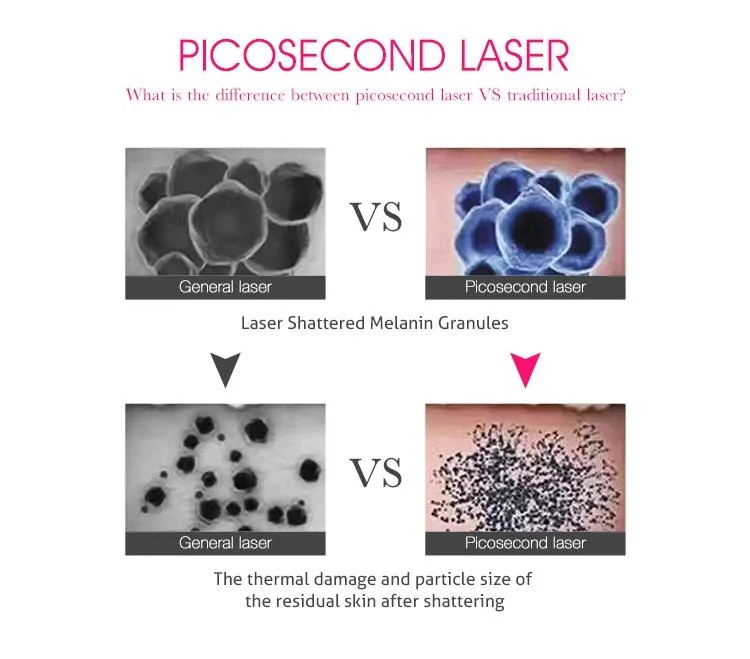 Factory Pico Second Laser Switched ND YAG Pico Laser 1064nm/532nm/755nm Picosecond Laser Tattoo Removal Machine