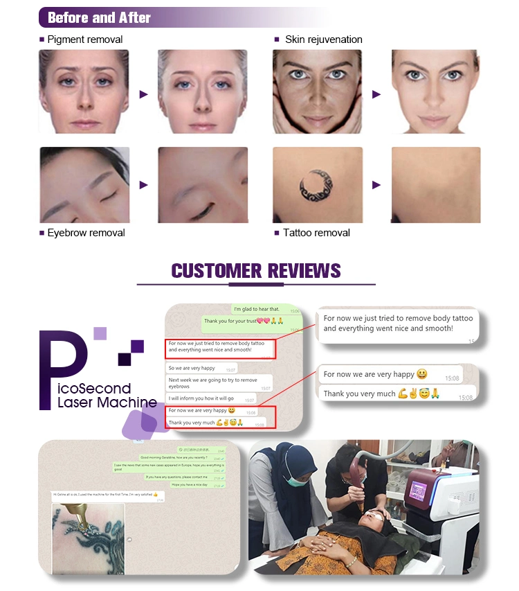 Pico Laser Tattoo Removal ND YAG Laser Skin Care Pigment Removal Therapy Beauty Machine Price