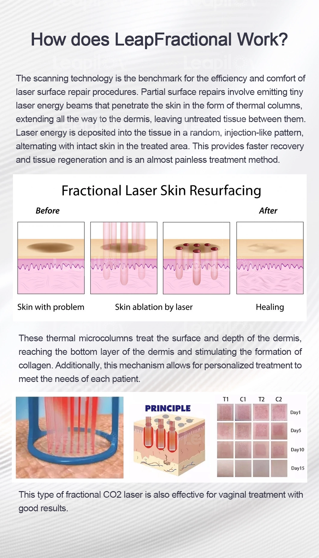 Smooth Skin Surgical Scars and Burns Fractional CO2 Vaginal Tightening Laser Machine